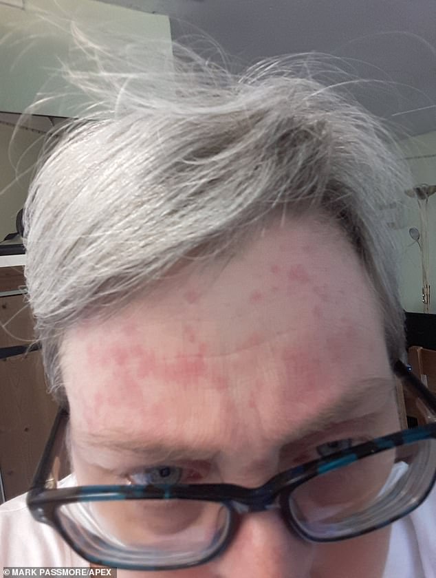 Mrs Knight has suffered with problematic skin for her whole life, and she can now develop allergic symptoms even if she leaves the window open during roadworks or touches newspaper ink, she claims